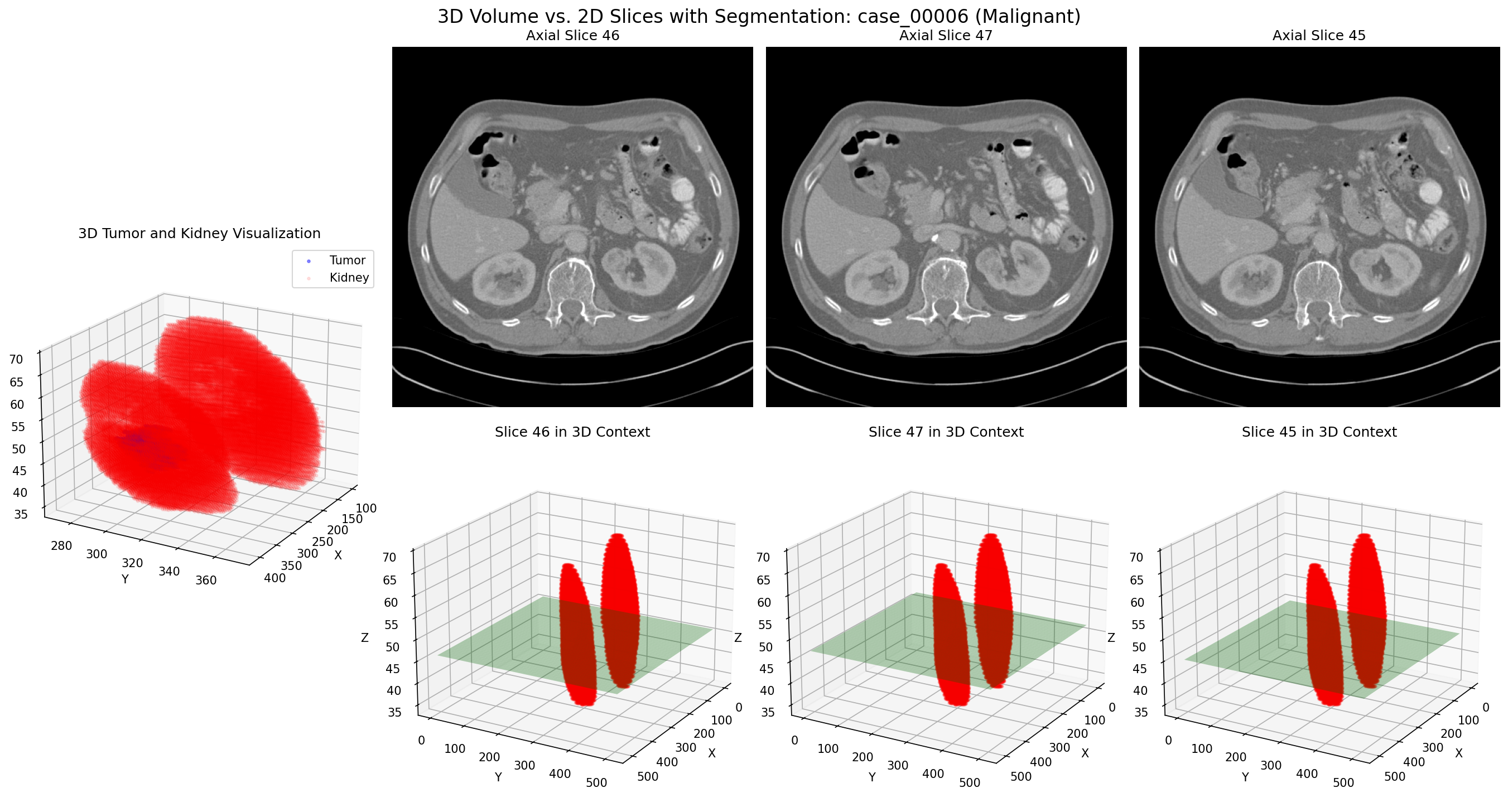 Case 00006: 3D volume (top row) and corresponding 2D slices (bottom row) of a malignant kidney tumor