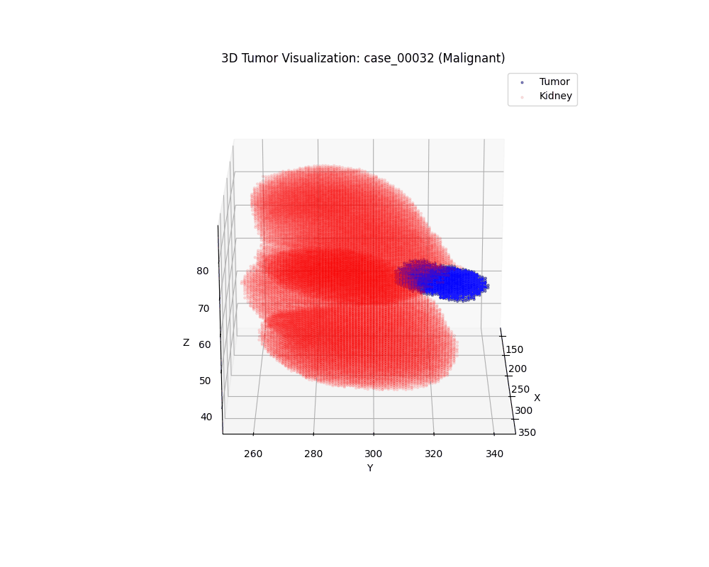 3D rotation of malignant kidney tumor - Case 00032