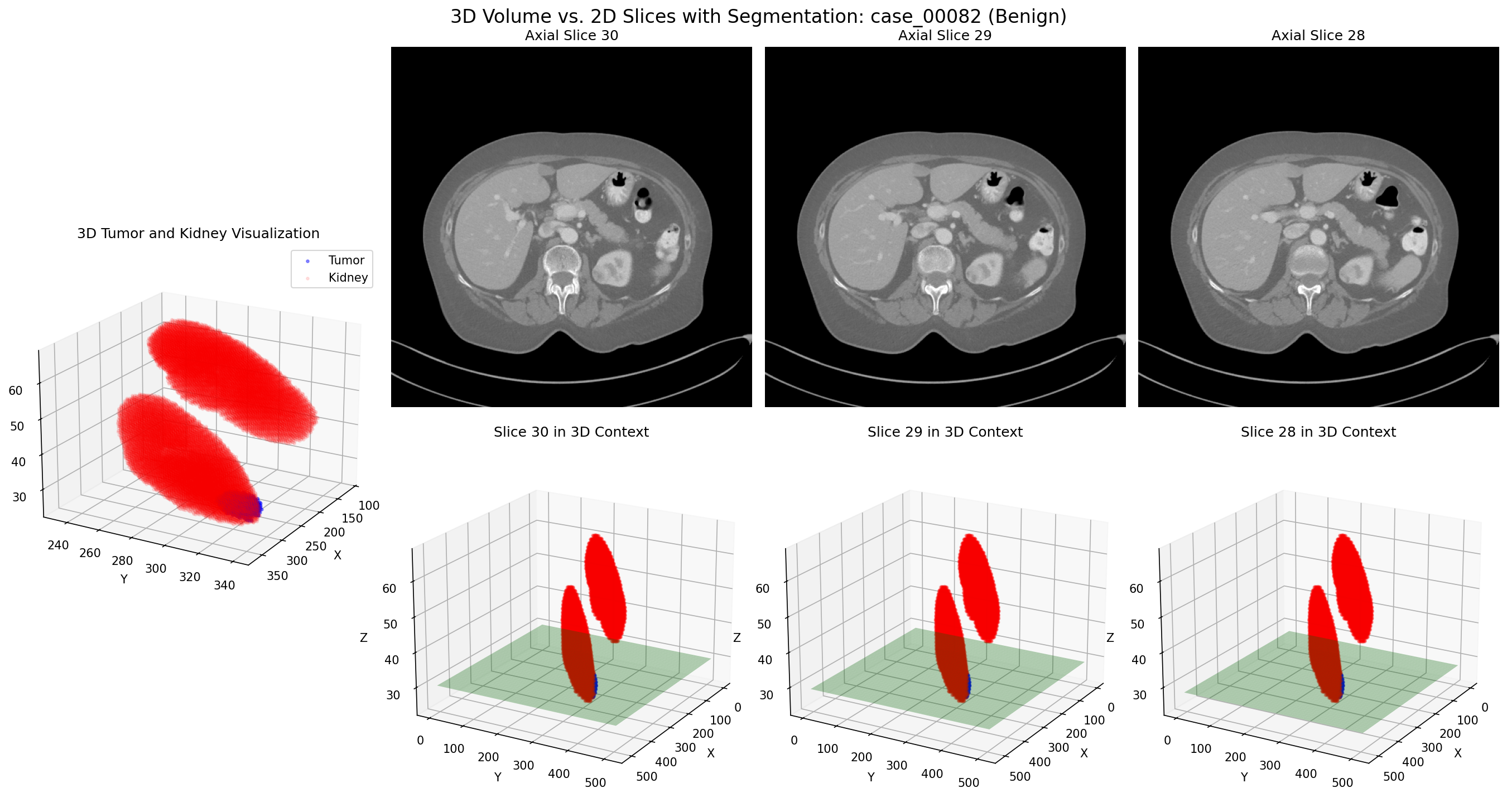 Case 00082: Early-stage benign tumor with 3D volume visualization (top) and optimal 2D slice selection (bottom)