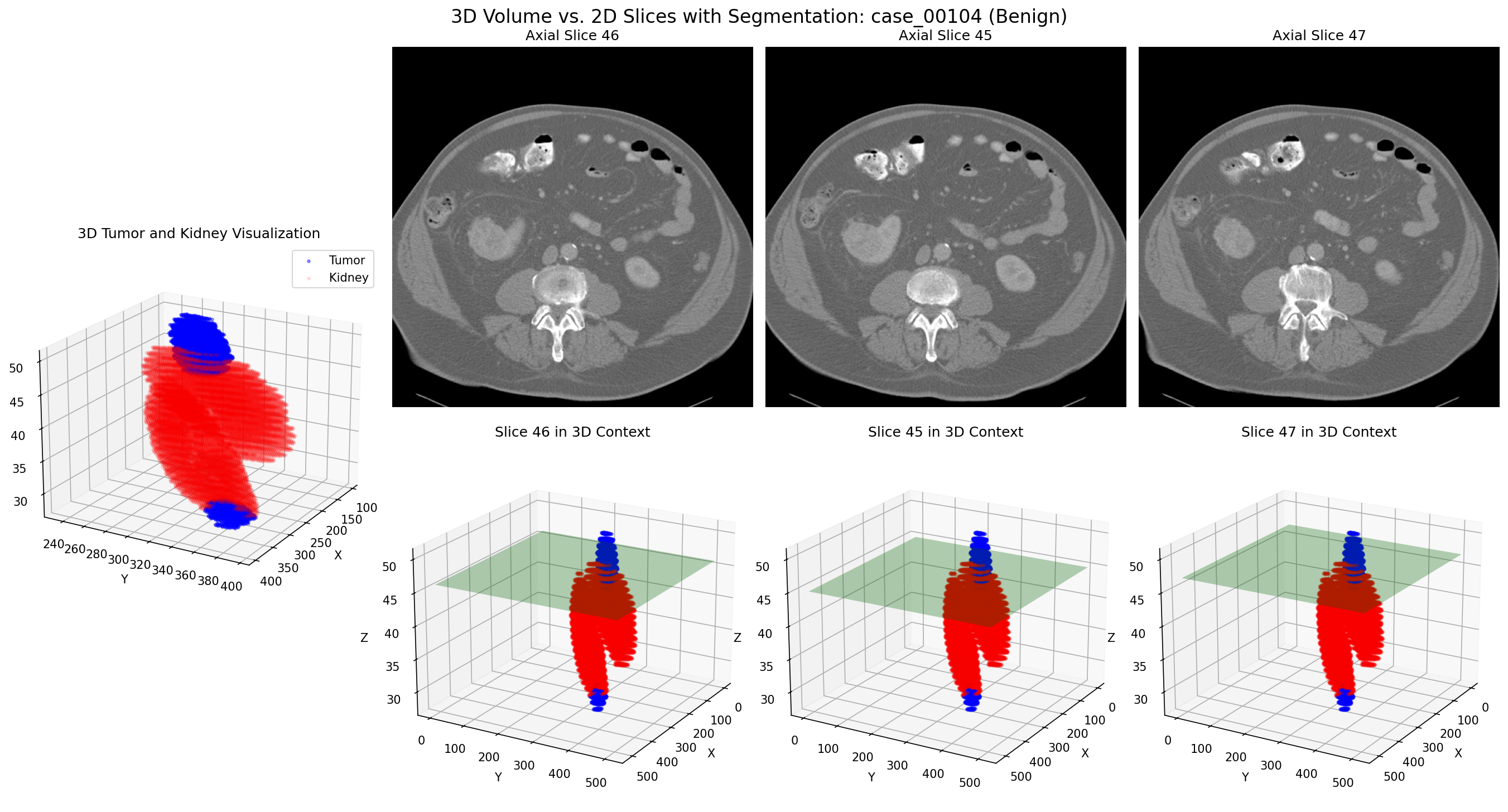 Case 00104: Advanced malignant tumor with 3D volume visualization (top) and optimal 2D slice selection (bottom)