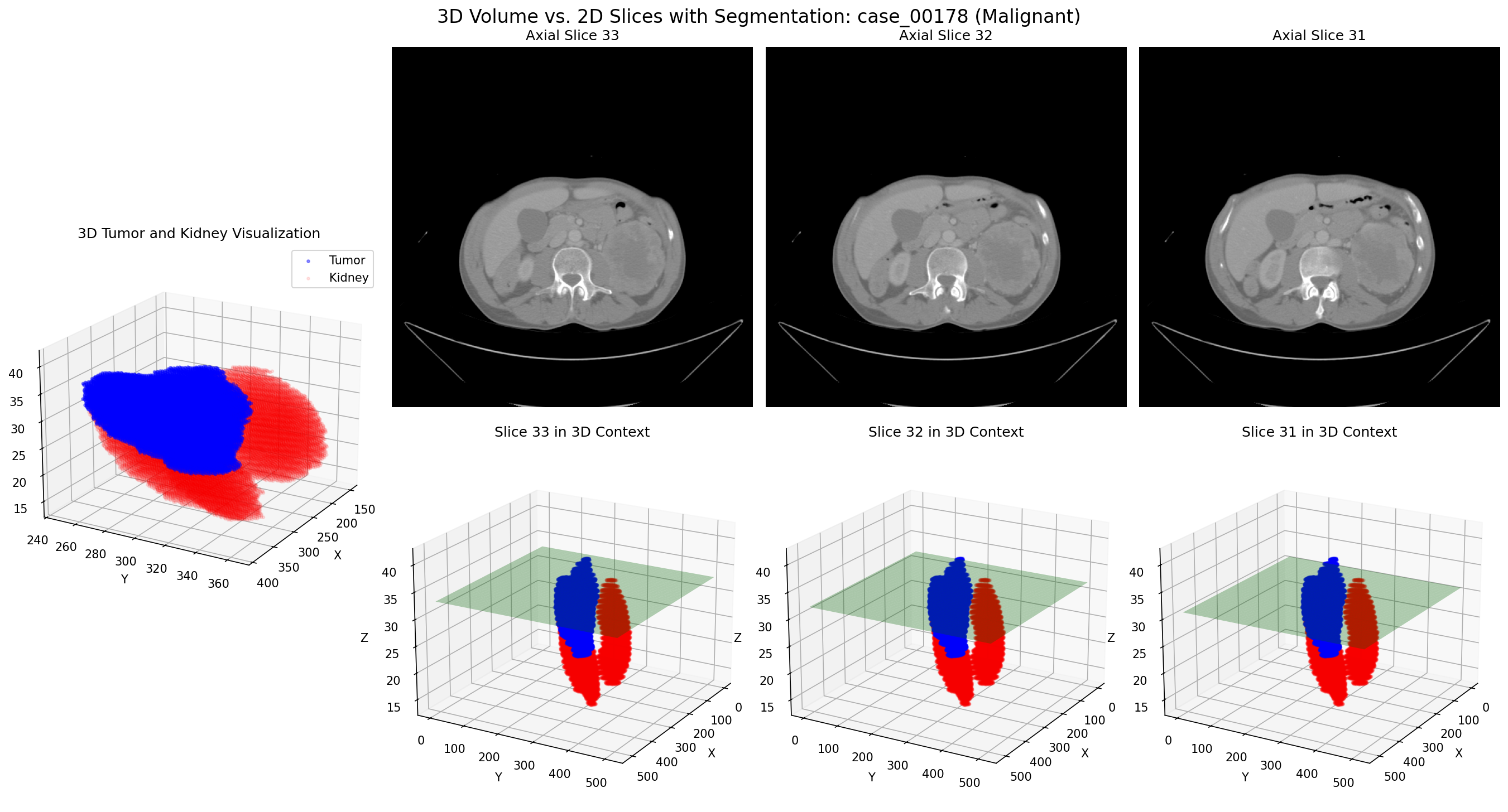 Case 00178: 3D volume (top row) and corresponding 2D slices (bottom row) of a benign kidney tumor
