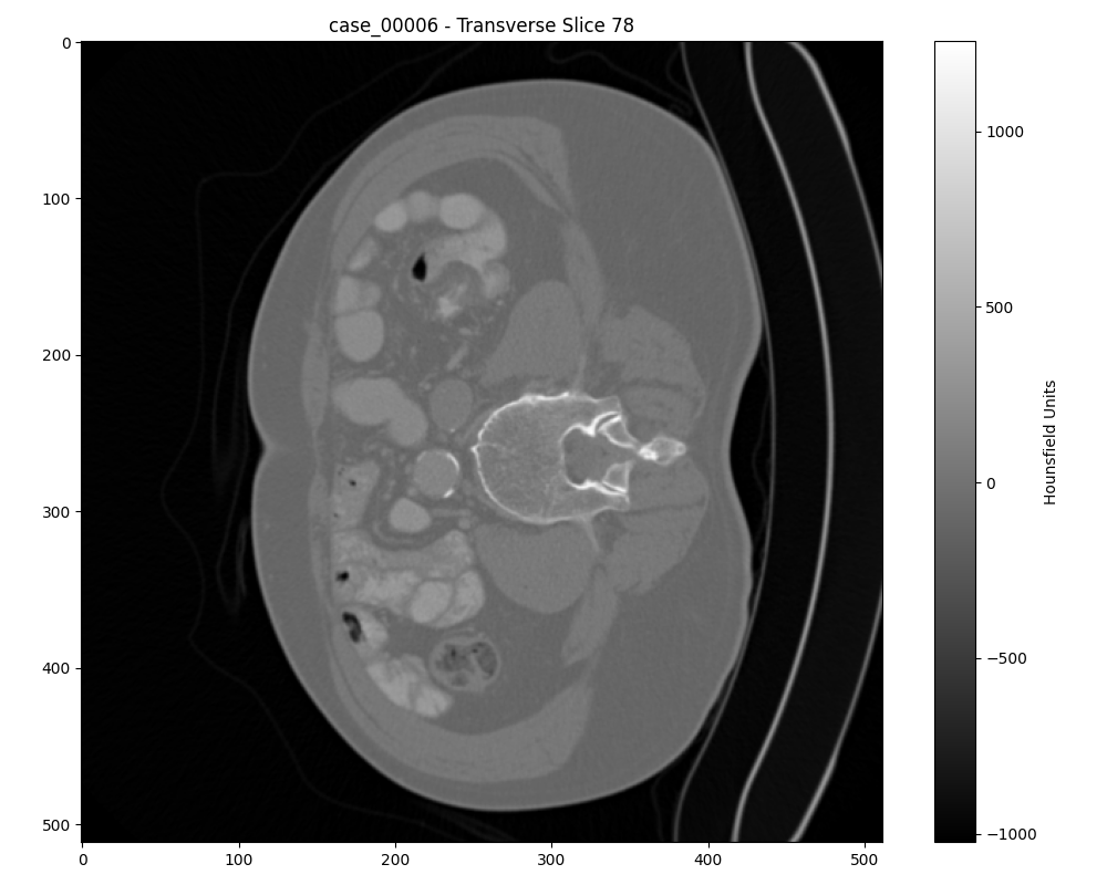 Axial slice of a malignant tumor