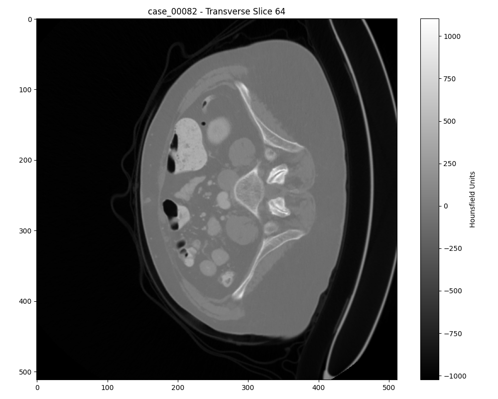 Axial slice of a benign tumor